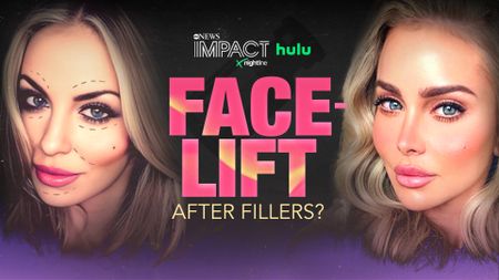 IMPACT x Nightline: “Facelift: After Fillers?”